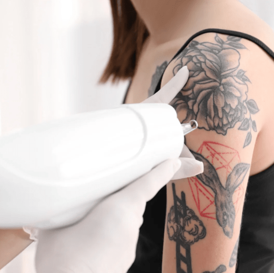 Laser tattoo removal on a woman's arm tattoo