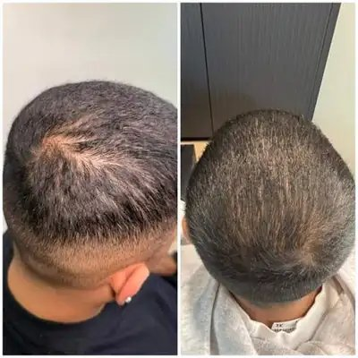 Client crown before and after hair treatment at SSKN Firm
