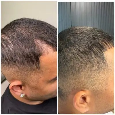 Client hairline before and after hair treatment at SSKN Firm