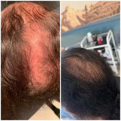 Client scalp before and after hair treatment at SSKN Firm