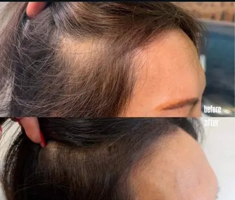 Client temple hairline before and after hair treatment at SSKN Firm, showing fuller, darker hair after