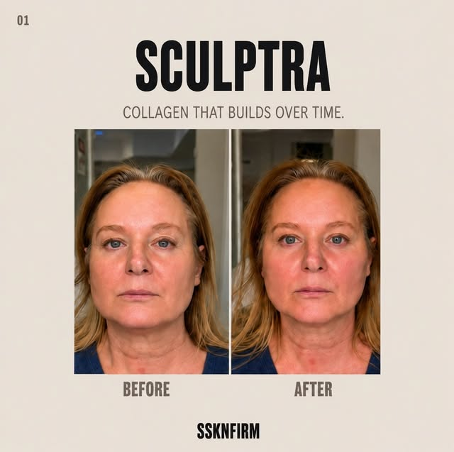 Main Home Sculptra before and after at SSKN Firm