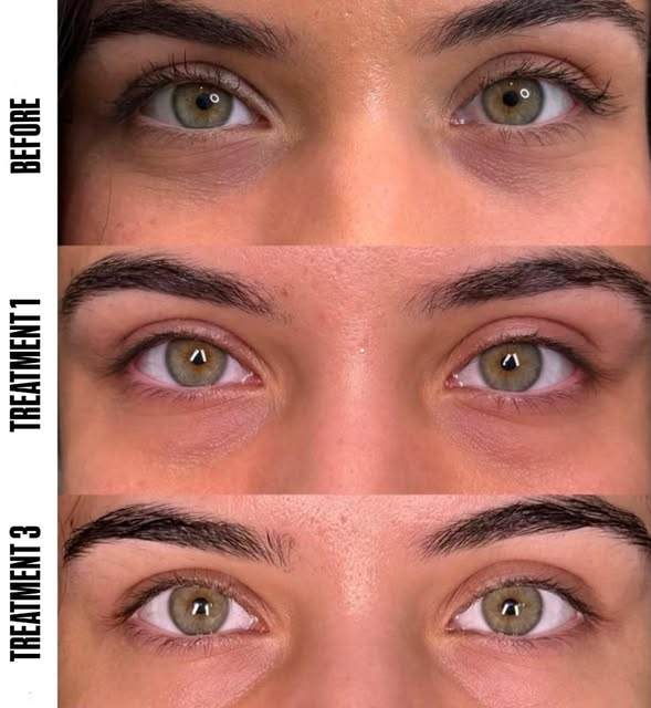 Main Home Under-eye treatment before and after at SSKN Firm